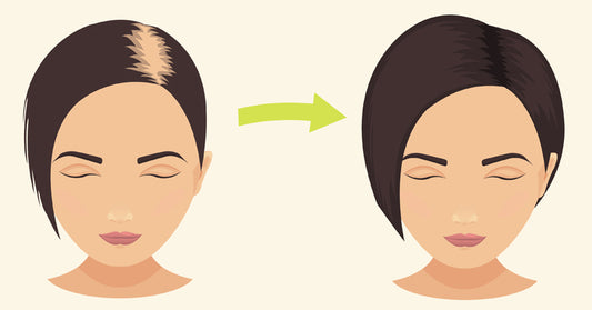 Alopecia Areata FI