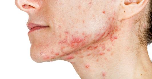 10 Home Remedies For Acne