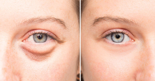 Evening Baggy Eye Solution That Removes Puffiness FAST!