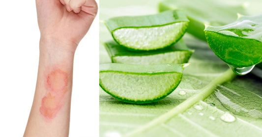 5 Home Remedies For Burn Relief + Foods To Eat & Avoid