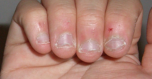 chew nail biting FI