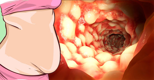 colitis obesity FI