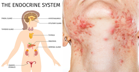 foods destroy hormones skin FI