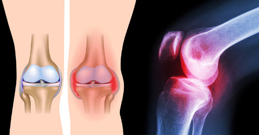 knee pain 3 steps FI