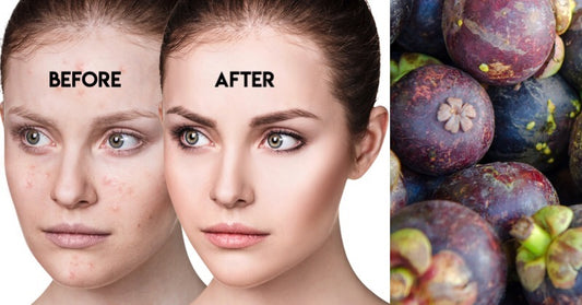 Mangosteen: 7 Benefits & Uses