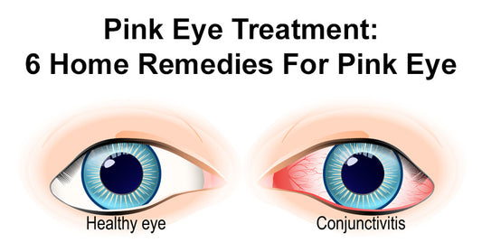 Pink Eye Treatment: 6 Home Remedies For Pink Eye