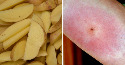 potato spider bite FI