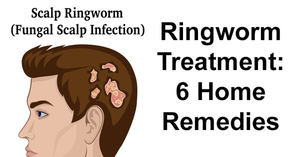 Ringworm Treatment: 6 Home Remedies - David Wolfe Shop