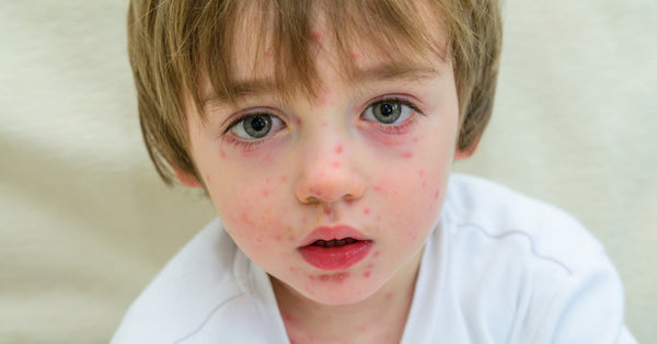 Natural Remedies For Children With Chicken Pox - David Wolfe Shop