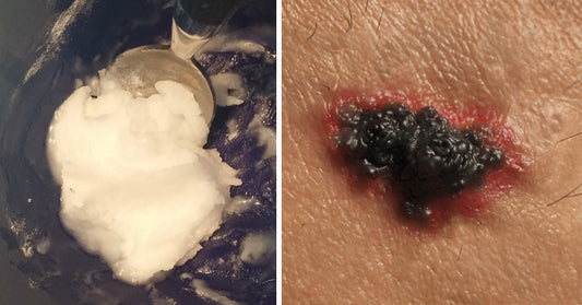 skin cancer baking soda FI