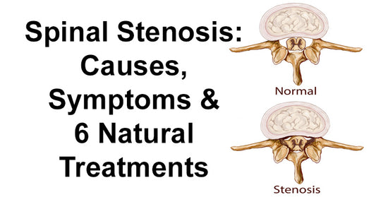 Spinal Stenosis: Causes, Symptoms & 6 Natural Treatments