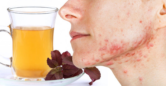 tea acne anxiety FI