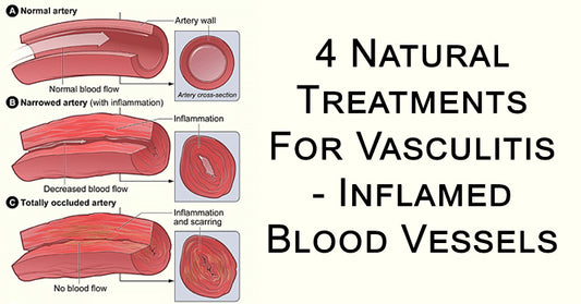 vasculitis FI