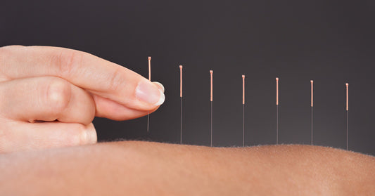 What Is Acupuncture? 6 Benefits To Consider